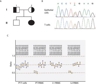 Case Report: Hypomorphic Function and Somatic Reversion in DOCK8 Deficiency in One Patient With Two Novel Variants and Sclerosing Cholangitis